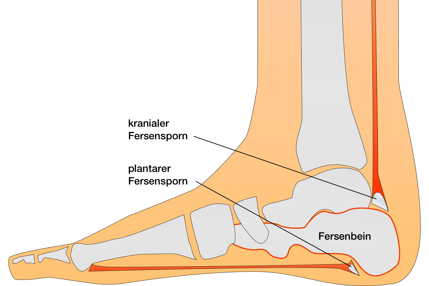 Fersenschmerz