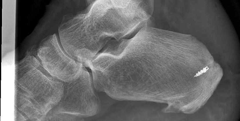 Haglund Sporn Post-OP