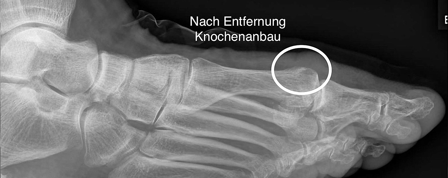 Rigidus Cheilektomie Post-OP