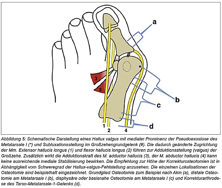 Hallux Valgus