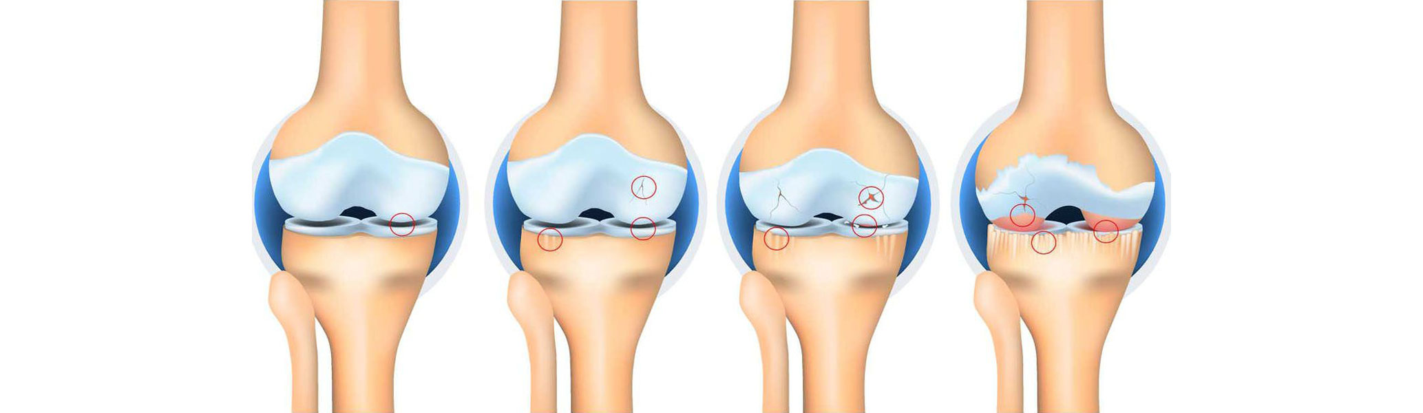 Arthrose